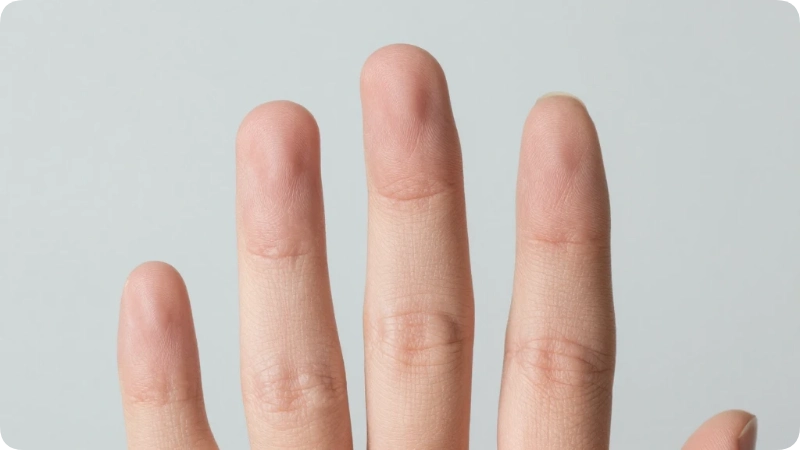 What Does Scabies Look Like on Hands